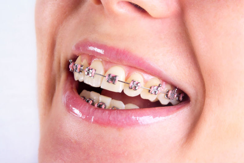 How to Maintain Your Clear Braces in Oxnard, CA