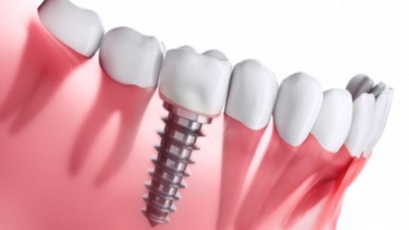 Teeth Implants In Hamilton, GA Will Restore Your Smile And Improve Your Health