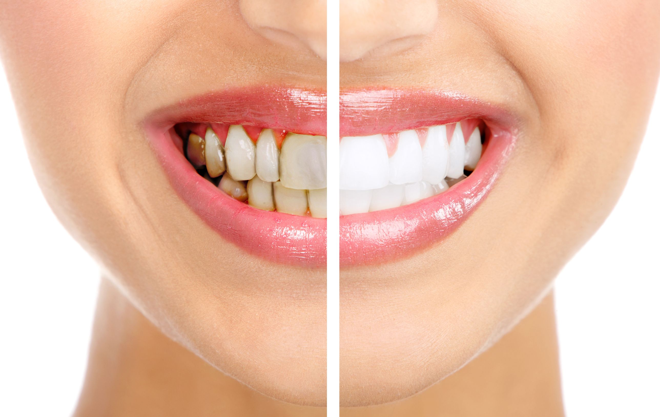 Best Options For Teeth Whitening OKC