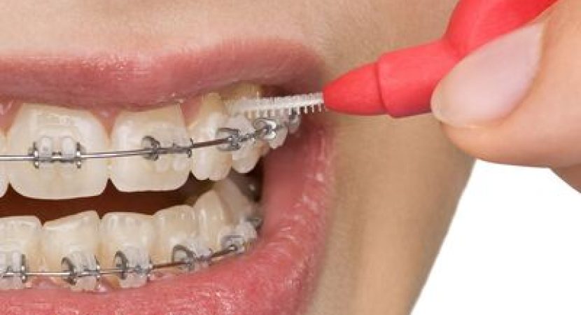 Is Invisalign in Medina OH The Right Choice For You?